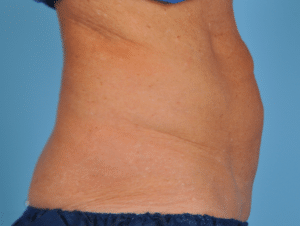 Before Image: CoolSculpting – Abdomen