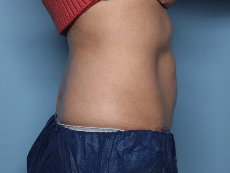 After Image: CoolSculpting – Abdomen - right-side