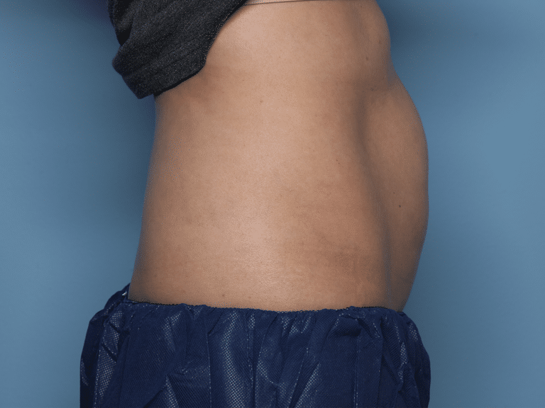 Before Image: CoolSculpting – Abdomen - right-side