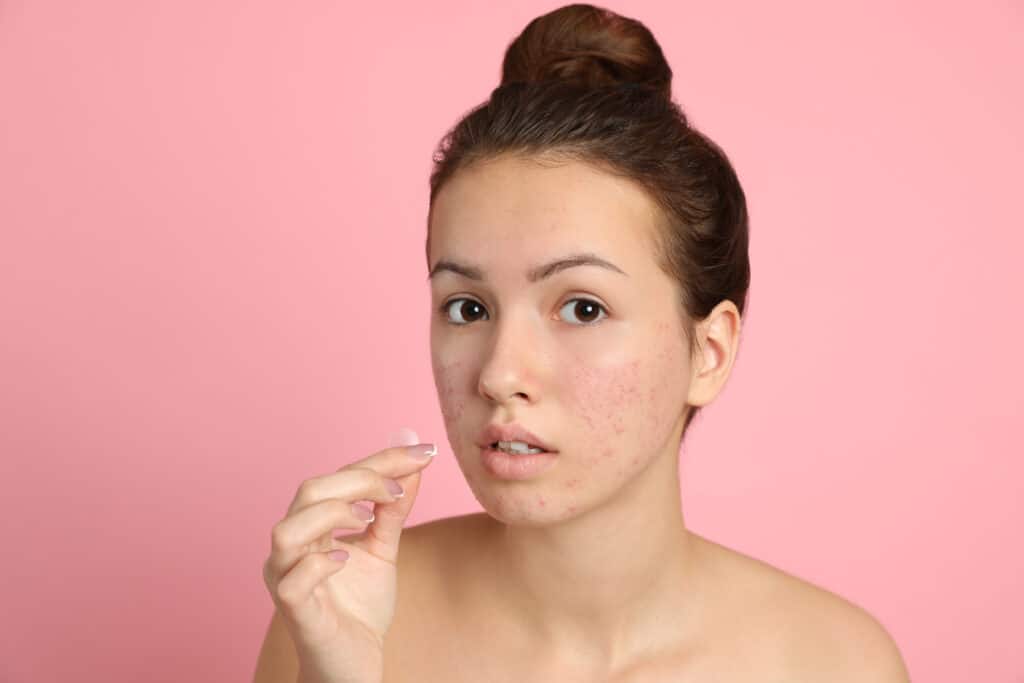 Girl with healing acne and some acne scarring on her face